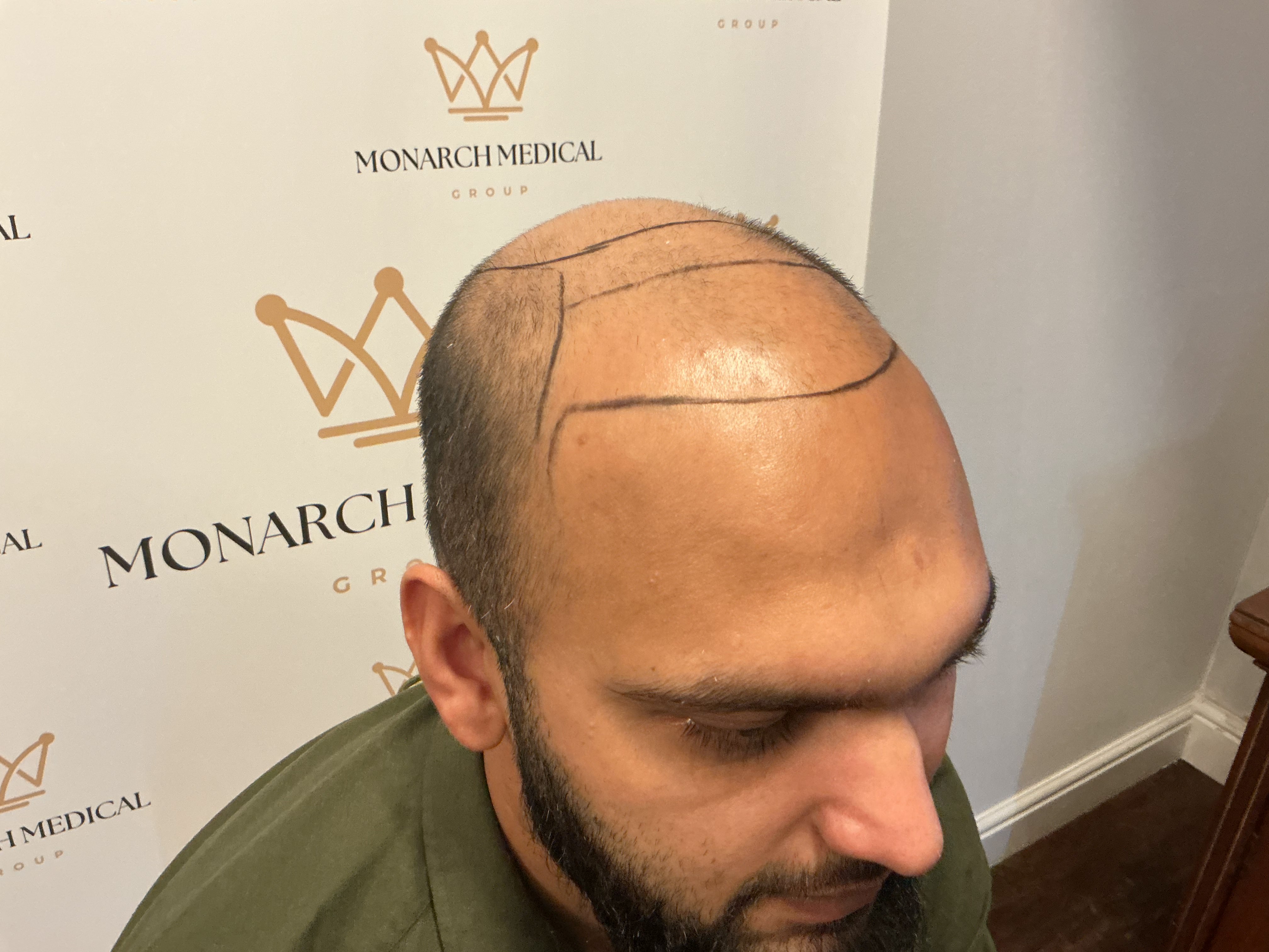 Norwood 7 hair transplant — Hussain result photo 2